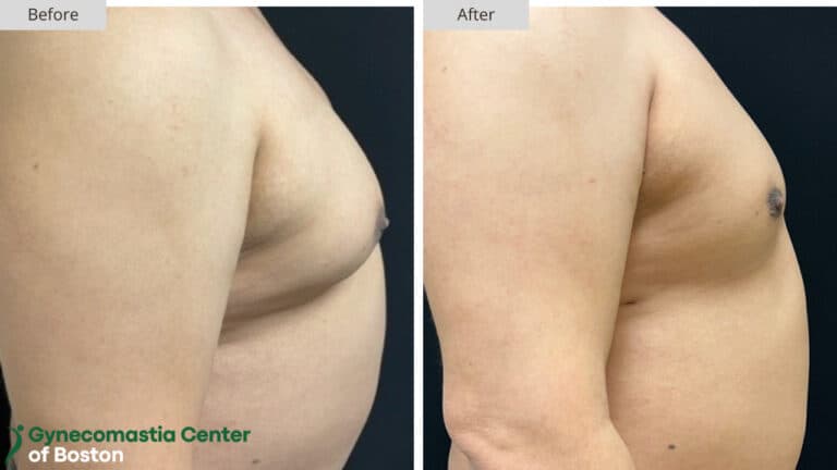 Gynecomastia Center of Boston Grade 1 Before and After