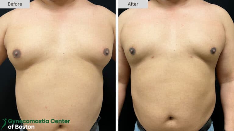 Gynecomastia Center of Boston Grade 1 Before and After