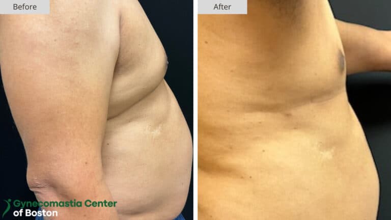 Gynecomastia Center of Boston Grade 3 Before and After