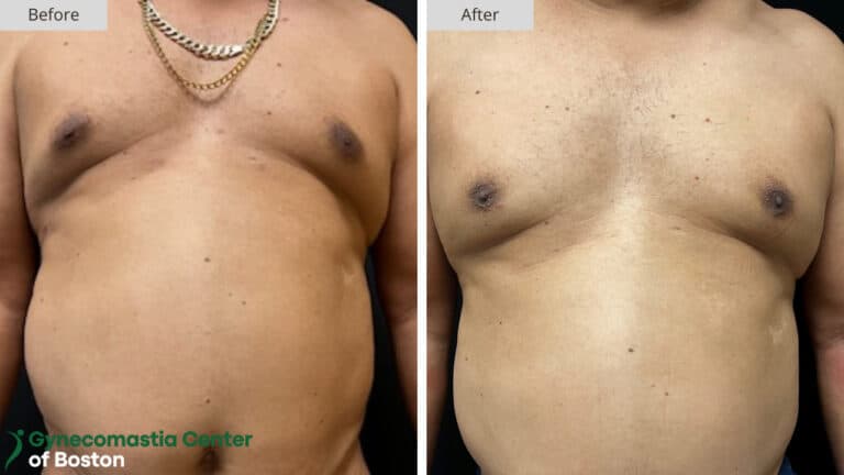 Gynecomastia Center of Boston Grade 3 Before and After