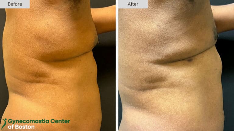 Gynecomastia Center of Boston Grade 4 Before and After