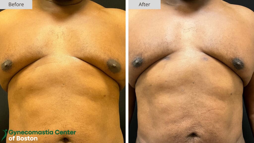 Boston Gynecomastia Surgery Before After Results Boston Gynecomastia Surgery Before After Results