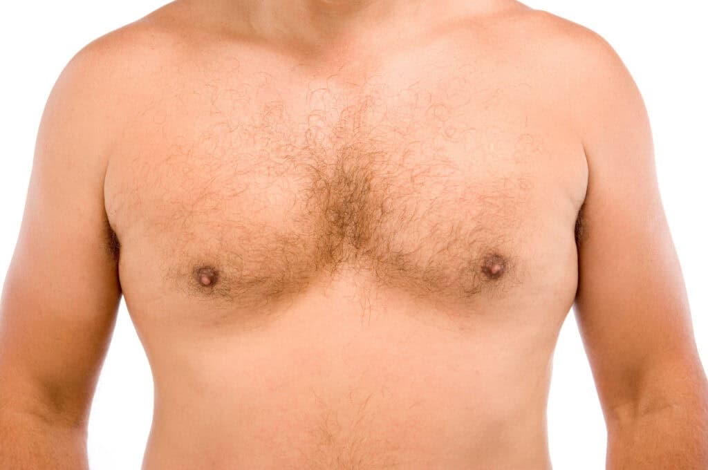 Are Gynecomastia Surgery Results Permanent What to Expect Long-Term