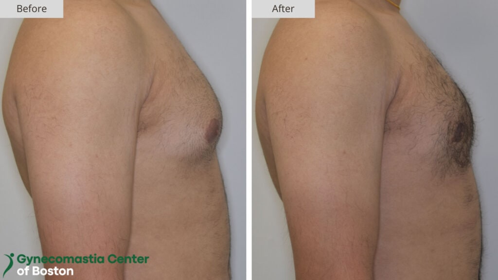 Gynecomastia Center of Boston Before and After 11a