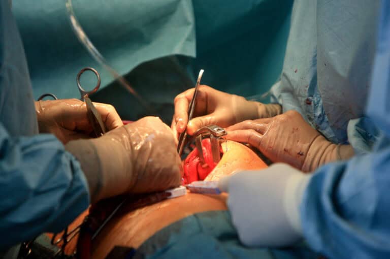 combining procedures with gynecomastia surgery