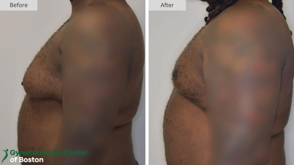 Gynecomastia Center of Boston Before and After
