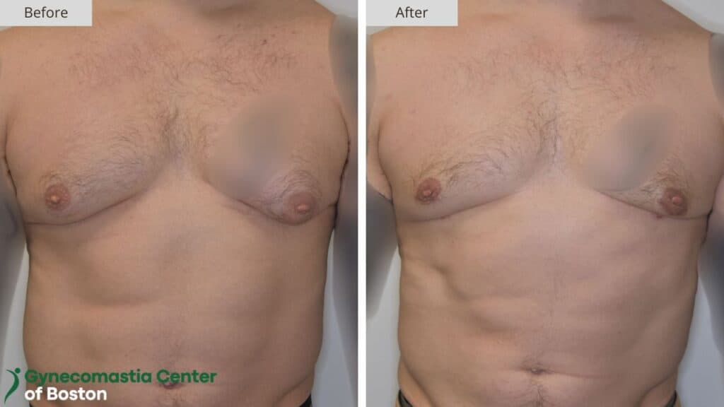 Gynecomastia Center of Boston Before and After