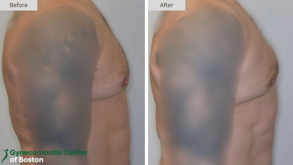 Gynecomastia Center of Boston Before and After
