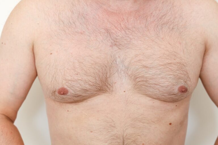 front of a topless man with gynecomastia