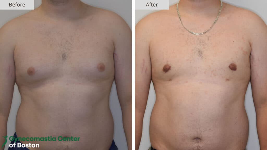 Gynecomastia Center of Boston Before and After 16a