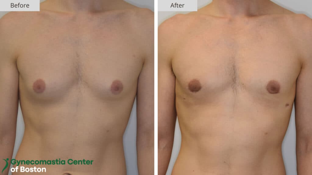 Gynecomastia Center of Boston Before and After 17a