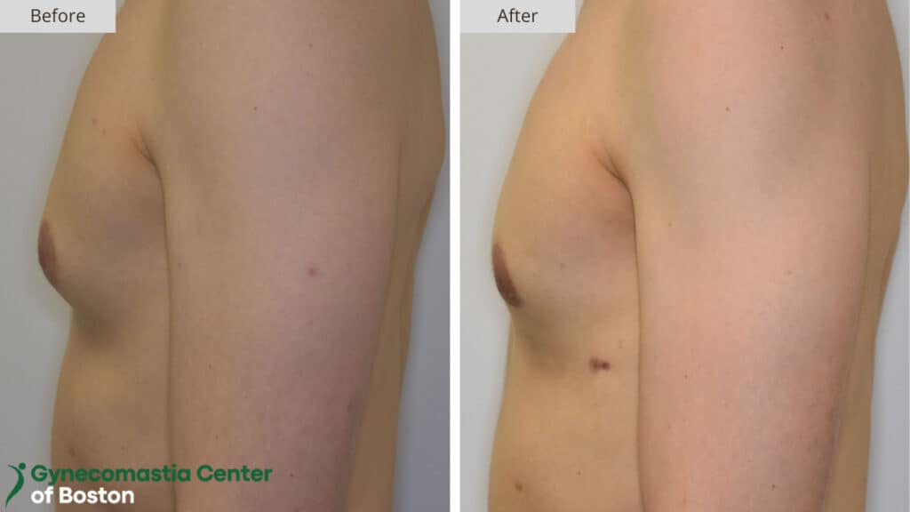 Gynecomastia Center of Boston Before and After 17b