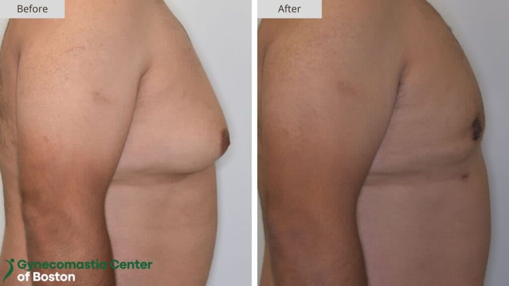 Gynecomastia Center of Boston Before and After 18b