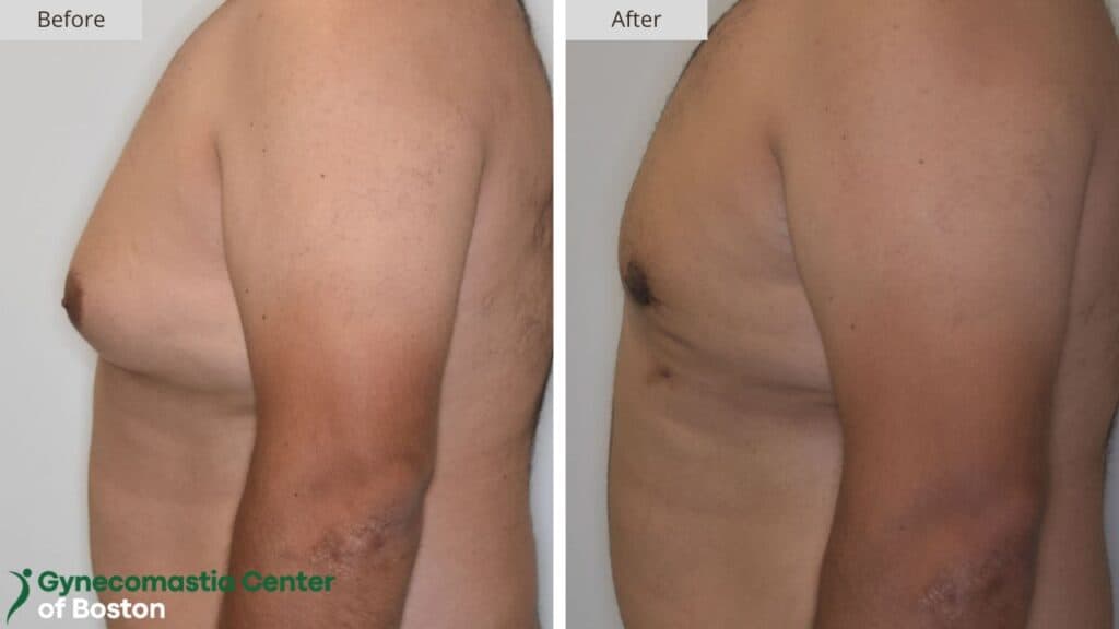 Gynecomastia Center of Boston Before and After 18b