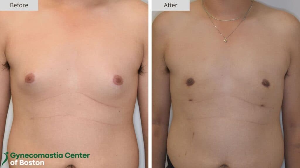 Gynecomastia Center of Boston Before and After 19a