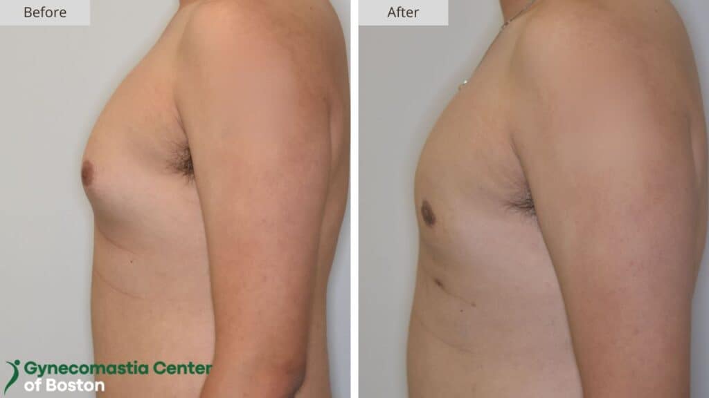 Gynecomastia Center of Boston Before and After 19b