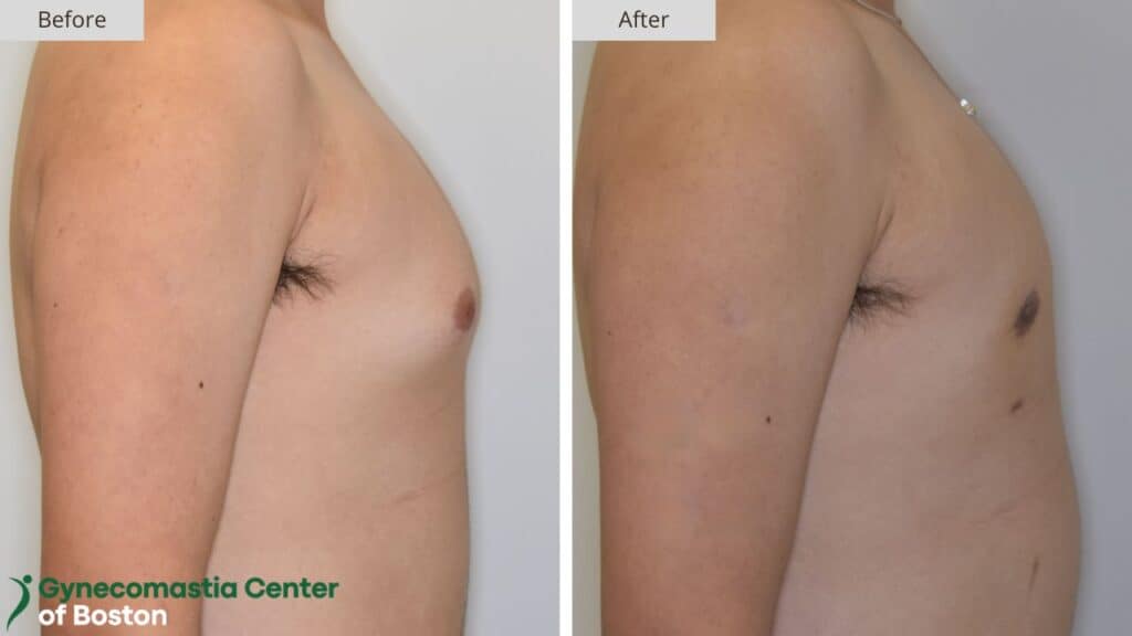 Gynecomastia Center of Boston Before and After 19c