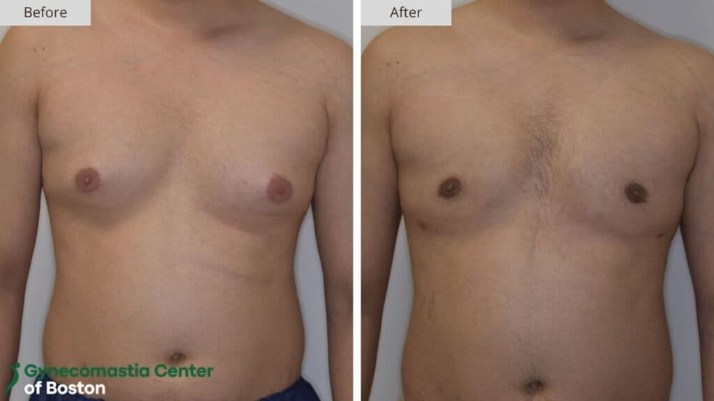 Gynecomastia Center of Boston Before and After 20a