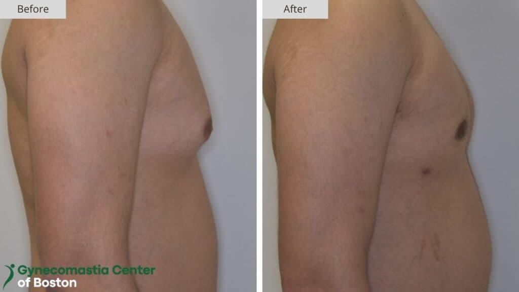 Gynecomastia Center of Boston Before and After 20b