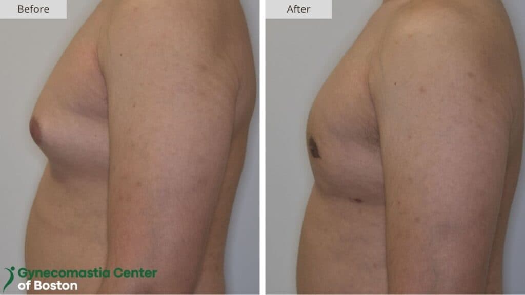 Gynecomastia Center of Boston Before and After 20c